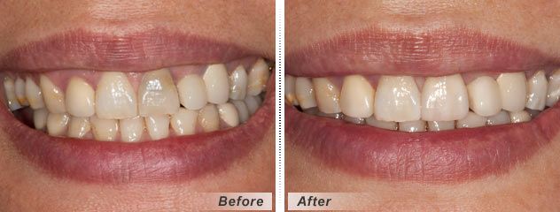 dental-crowns-before-after