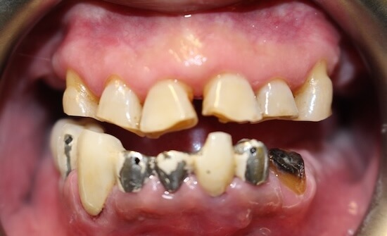 Stanley Before
