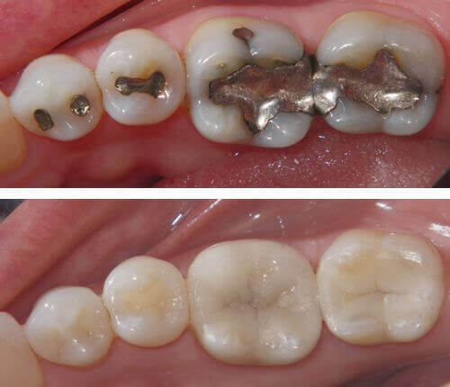 composite-resin-dental-filling