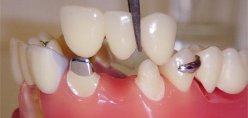 dental-bridges