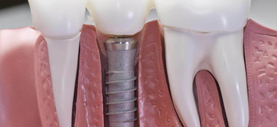 dental-implants