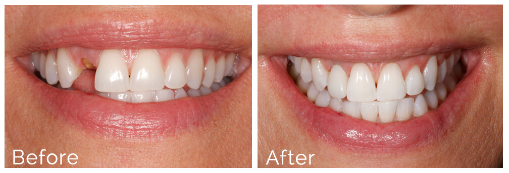 dental-implants-before-after