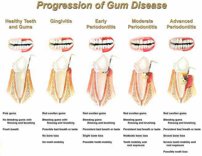 gum-disease