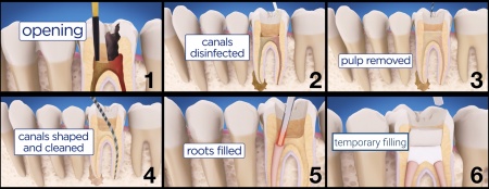 root-canal-treatment