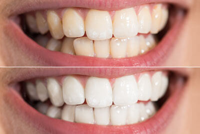 teeth-whitening